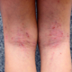 dermatite atopica sulle gambe